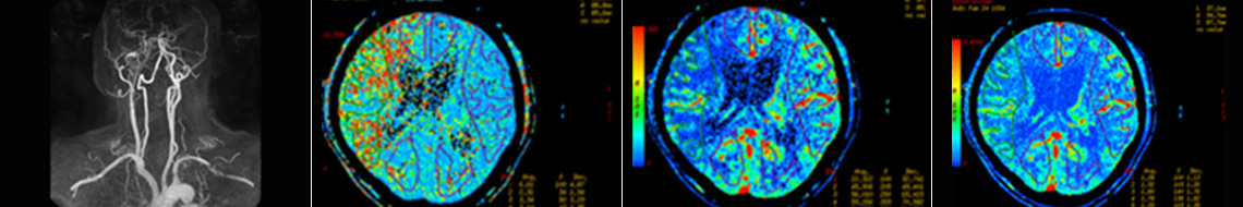 뇌 CT혈류검사