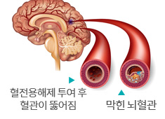 뇌 혈관에서 혈전전용해제 투여 후 혈관이 뚫어지는 혈관과 막힌 뇌혈관